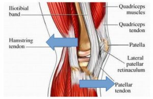 Tendinitis de isquiotibiales