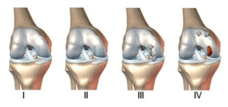 Condromalacia Rotuliana Grados De Degeneraci N Tecnirunner